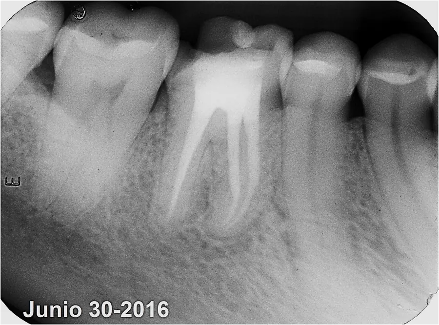 Radiografía de un molar con tratamiento de conductos