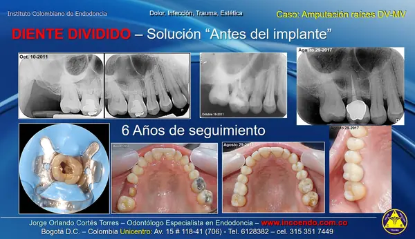 Diente dividido que se conservó. Molar inferior · Seguimiento 6 años. Caso clínico del Instituto Colombiano de Endodoncia