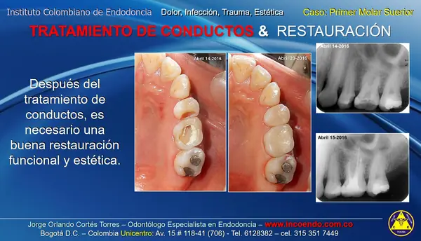 Tratamiento de conductos y restauración. Primer molar superior · Restauración. Caso clínico del Instituto Colombiano de Endodoncia