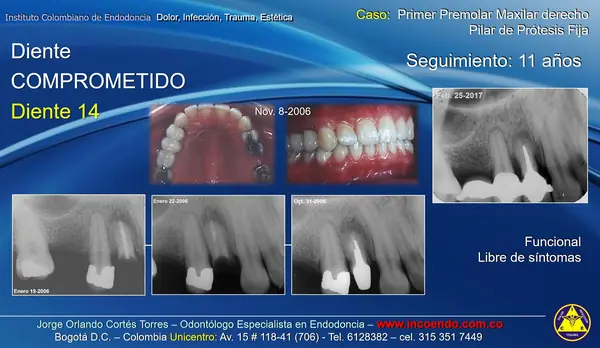 Diente comprometido que sigue funcionando. Diente 14 · Seguimiento 11 años. Caso clínico del Instituto Colombiano de Endodoncia