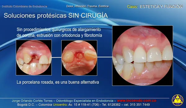Solución protésica sin cirugía. Estética · Porcelana rosada. Caso clínico del Instituto Colombiano de Endodoncia