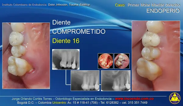 Lesión endoperiodontal. Diente 16 · Diente comprometido. Caso clínico del Instituto Colombiano de Endodoncia