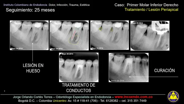 Lesión en el hueso que sanó con endodoncia. Diente 46 · Seguimiento 25 meses. Caso clínico del Instituto Colombiano de Endodoncia