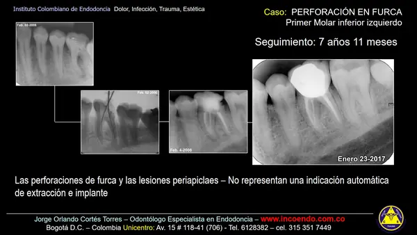 Reparación de perforación en furca. Diente 36 · Seguimiento 7 años 11 meses. Caso clínico del Instituto Colombiano de Endodoncia