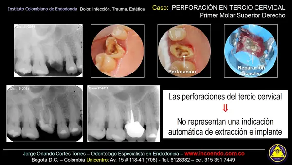 Reparación de perforación cervical. Diente 16 · Reparación. Caso clínico del Instituto Colombiano de Endodoncia