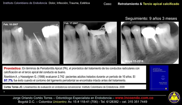 Retratamiento con conducto calcificado. Diente 36 · Seguimiento 9 años 3 meses. Caso clínico del Instituto Colombiano de Endodoncia