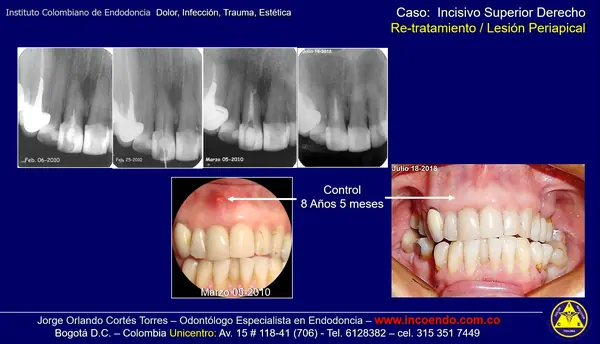 Retratamiento de incisivo superior. Diente 11 · Seguimiento 8 años 5 meses. Caso clínico del Instituto Colombiano de Endodoncia