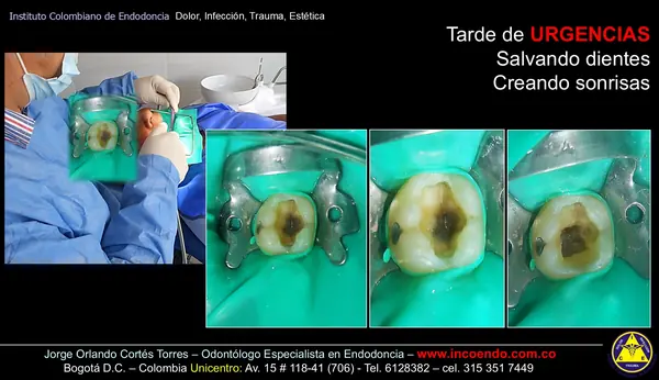 Tarde de urgencias: salvando dientes. Urgencia · Aislamiento absoluto. Caso clínico del Instituto Colombiano de Endodoncia