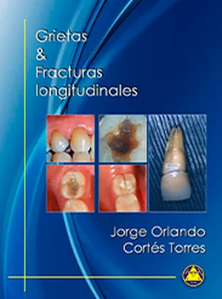 Cover of Grietas y fracturas longitudinales